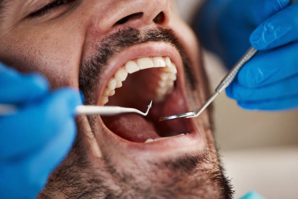 Best Teeth Whitening  in Bernie, MO