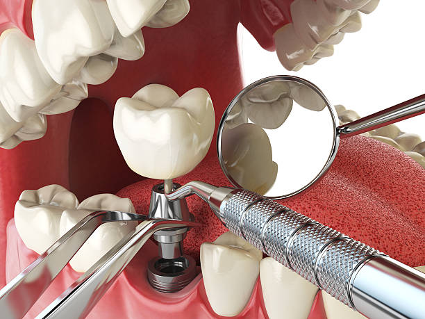 Best Chipped Tooth Repair Near Me  in Bernie, MO